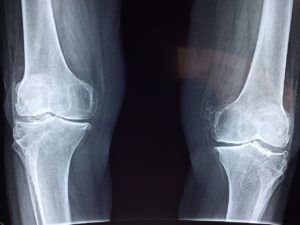 defective knee replacement