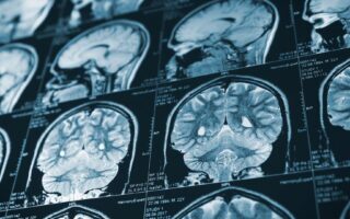How Much Compensation Can You Get for a Brain Injury in Arkansas?