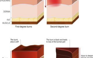 Common Injuries Burns