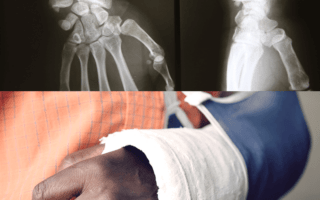 Broken Bones & Fractures Attorney Little Rock, Arkansas